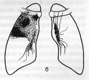 Инфильтративный туберкулез легких представляет собой участки туберкулезной бронхопневмонии, формирующиеся в пределах дольковой структуры легкого