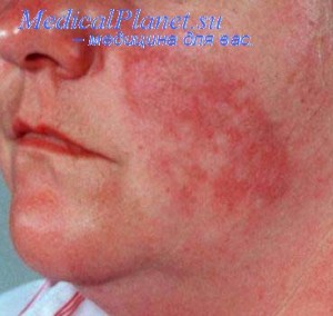 Туберкулез кожи колликвативный — вторая по частоте форма туберкулеза кожи