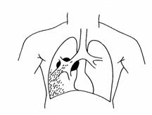 Казеозная пневмония наблюдается при прогрессировании инфильтративного туберкулеза