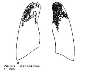 При цирротическом туберкулезе в пораженных легких вокруг каверн происходит развитие соединительной ткани